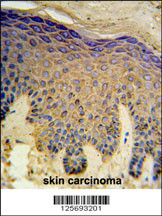 HAUS4 Antibody (C-term) (Cat. #AP5229b) IHC analysis in formalin fixed and paraffin embedded skin carcinoma followed by peroxidase conjugation of the secondary antibody and DAB staining. This data demonstrates the use of the HAUS4 Antibody (C-term) for immunohistochemistry. Clinical relevance has not been evaluated.