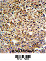 KIAA1529 Antibody (C-term) (Cat. #AP5165b) IHC analysis in formalin fixed and paraffin embedded human cervix carcinoma followed by peroxidase conjugation of the secondary antibody and DAB staining. This data demonstrates the use of the KIAA1529 Antibody (C-term) for immunohistochemistry. Clinical relevance has not been evaluated.