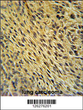 CCDC62 Antibody (C-term) (Cat. #AP5157b) immunohistochemistry analysis in formalin fixed and paraffin embedded human lung carcinoma followed by peroxidase conjugation of the secondary antibody and DAB staining. This data demonstrates the use of the CCDC62 Antibody (C-term) for immunohistochemistry. Clinical relevance has not been evaluated.