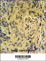 TESC Antibody (C-term) (Cat. #AP5136b) IHC analysis in formalin fixed and paraffin embedded human lung carcinoma followed by peroxidase conjugation of the secondary antibody and DAB staining. This data demonstrates the use of the TESC Antibody (C-term) for immunohistochemistry. Clinical relevance has not been evaluated.