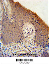 KRTAP1-1 Antibody (Center) (Cat. #AP5050c) immunohistochemistry analysis in formalin fixed and paraffin embedded human skin carcinoma followed by peroxidase conjugation of the secondary antibody and DAB staining. This data demonstrates the use of the KRTAP1-1 Antibody (Center) for immunohistochemistry. Clinical relevance has not been evaluated.