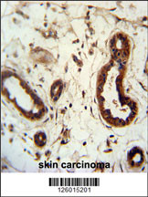 KRT82 Antibody (Center) (Cat. #AP5049c) immunohistochemistry analysis in formalin fixed and paraffin embedded human skin carcinoma followed by peroxidase conjugation of the secondary antibody and DAB staining. This data demonstrates the use of the KRT82 Antibody (Center) for immunohistochemistry. Clinical relevance has not been evaluated.