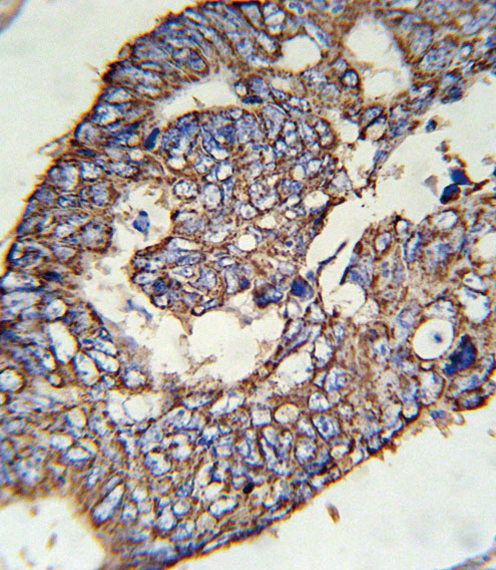 SLC47A1 Antibody (C-term) (Cat. #AP5354b) immunohistochemistry analysis in formalin fixed and paraffin embedded human colon carcinoma followed by peroxidase conjugation of the secondary antibody and DAB staining. This data demonstrates the use of the SLC47A1 Antibody (C-term) for immunohistochemistry. Clinical relevance has not been evaluated.