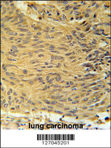 LCLT1 Antibody (C-term) (Cat. #AP5723b) immunohistochemistry analysis in formalin fixed and paraffin embedded human lung carcinoma followed by peroxidase conjugation of the secondary antibody and DAB staining. This data demonstrates the use of the LCLT1 Antibody (C-term) for immunohistochemistry. Clinical relevance has not been evaluated.