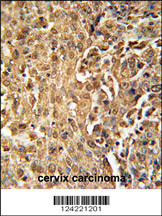 ZC3HAV1 Antibody (C-term) (Cat. #AP5695b) immunohistochemistry analysis in formalin fixed and paraffin embedded human cervix carcinoma followed by peroxidase conjugation of the secondary antibody and DAB staining. This data demonstrates the use of the ZC3HAV1 Antibody (C-term) for immunohistochemistry. Clinical relevance has not been evaluated.