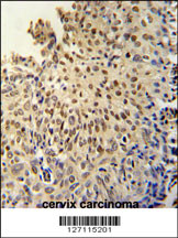 DI3L1 Antibody (N-term) (Cat. #AP5614a) immunohistochemistry analysis in formalin fixed and paraffin embedded human cervix carcinoma followed by peroxidase conjugation of the secondary antibody and DAB staining. This data demonstrates the use of the DI3L1 Antibody (N-term) for immunohistochemistry. Clinical relevance has not been evaluated.