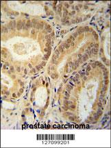 RBM24 Antibody (N-term) (Cat. #AP5609a) immunohistochemistry analysis in formalin fixed and paraffin embedded human prostate carcinoma followed by peroxidase conjugation of the secondary antibody and DAB staining. This data demonstrates the use of the RBM24 Antibody (N-term) for immunohistochemistry. Clinical relevance has not been evaluated.