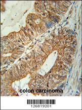 TSPAN3 Antibody (Center) (Cat. #AP5559c) immunohistochemistry analysis in formalin fixed and paraffin embedded human colon carcinoma followed by peroxidase conjugation of the secondary antibody and DAB staining. This data demonstrates the use of the TSPAN3 Antibody (Center) for immunohistochemistry. Clinical relevance has not been evaluated.