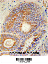HHAT Antibody (N-term) (Cat. #AP5503a) immunohistochemistry analysis in formalin fixed and paraffin embedded human prostate carcinoma followed by peroxidase conjugation of the secondary antibody and DAB staining. This data demonstrates the use of the HHAT Antibody (N-term) for immunohistochemistry. Clinical relevance has not been evaluated.