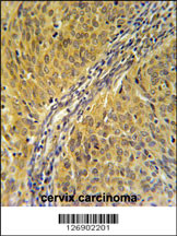 DYNC1LI2 Antibody (Center) (Cat. #AP5478c) immunohistochemistry analysis in formalin fixed and paraffin embedded human cervix carcinoma followed by peroxidase conjugation of the secondary antibody and DAB staining. This data demonstrates the use of the DYNC1LI2 Antibody (Center) for immunohistochemistry. Clinical relevance has not been evaluated.