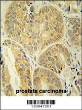 ENAM antibody(C-term) (Cat. #AP5838b) immunohistochemistry analysis in formalin fixed and paraffin embedded human prostate carcinoma followed by peroxidase conjugation of the secondary antibody and DAB staining. This data demonstrates the use of the ENAM antibody(C-term) for immunohistochemistry. Clinical relevance has not been evaluated.