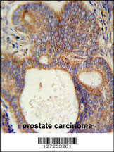 LYSMD1 Antibody (C-term) (Cat. #AP5745b) immunohistochemistry analysis in formalin fixed and paraffin embedded human prostate carcinoma followed by peroxidase conjugation of the secondary antibody and DAB staining. This data demonstrates the use of the LYSMD1 Antibody (C-term) for immunohistochemistry. Clinical relevance has not been evaluated.