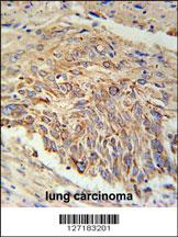 EBPL Antibody (C-term) (Cat. #AP5735b) immunohistochemistry analysis in formalin fixed and paraffin embedded human lung carcinoma followed by peroxidase conjugation of the secondary antibody and DAB staining. This data demonstrates the use of the EBPL Antibody (C-term) for immunohistochemistry. Clinical relevance has not been evaluated.