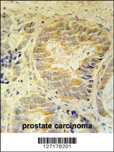 FAM105B Antibody (Center) (Cat. #AP5734c) immunohistochemistry analysis in formalin fixed and paraffin embedded human prostate carcinoma followed by peroxidase conjugation of the secondary antibody and DAB staining. This data demonstrates the use of the FAM105B Antibody (Center) for immunohistochemistry. Clinical relevance has not been evaluated.