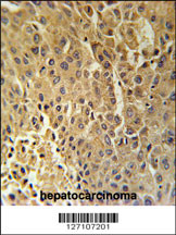 DHB13 Antibody (N-term) (Cat. #AP5729a) immunohistochemistry analysis in formalin fixed and paraffin embedded human hepatocarcinoma followed by peroxidase conjugation of the secondary antibody and DAB staining. This data demonstrates the use of the DHB13 Antibody (N-term) for immunohistochemistry. Clinical relevance has not been evaluated.