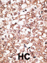 Formalin-fixed and paraffin-embedded human cancer tissue reacted with the primary antibody, which was peroxidase-conjugated to the secondary antibody, followed by AEC staining. This data demonstrates the use of this antibody for immunohistochemistry; clinical relevance has not been evaluated. BC = breast carcinoma; HC = hepatocarcinoma.