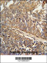 ATP13A3 antibody (N-term) (Cat. #AP5938a) immunohistochemistry analysis in formalin fixed and paraffin embedded human bladder carcinoma followed by peroxidase conjugation of the secondary antibody and DAB staining. This data demonstrates the use of the ATP13A3 antibody (N-term) for immunohistochemistry. Clinical relevance has not been evaluated.