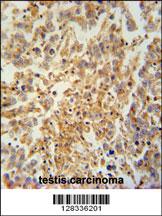 TEX9 antibody (N-term) (Cat. #AP10612a) immunohistochemistry analysis in formalin fixed and paraffin embedded human testis carcinoma followed by peroxidase conjugation of the secondary antibody and DAB staining. This data demonstrates the use of the TEX9 antibody (N-term) for immunohistochemistry. Clinical relevance has not been evaluated.
