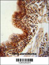 RBM43 antibody (N-term) (Cat. #AP10608a) immunohistochemistry analysis in formalin fixed and paraffin embedded human lung carcinoma followed by peroxidase conjugation of the secondary antibody and DAB staining. This data demonstrates the use of the RBM43 antibody (N-term) for immunohistochemistry. Clinical relevance has not been evaluated.