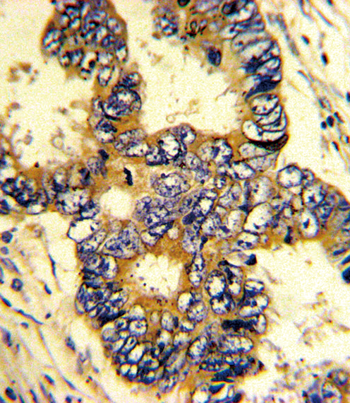 Formalin-fixed and paraffin-embedded human colon carcinoma with EPN3 Antibody (N-term), which was peroxidase-conjugated to the secondary antibody, followed by DAB staining. This data demonstrates the use of this antibody for immunohistochemistry; clinical relevance has not been evaluated.