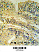 FKBP2 Antibody (N-term) (Cat. #AP6730a) IHC analysis in formalin fixed and paraffin embedded human Colon carcinoma followed by peroxidase conjugation of the secondary antibody and DAB staining. This data demonstrates the use of the FKBP2 Antibody (N-term) for immunohistochemistry. Clinical relevance has not been evaluated.