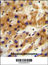 GAGE13 Antibody (N-term) (Cat. #AP10568a) immunohistochemistry analysis in formalin fixed and paraffin embedded human hepatocarcinoma followed by peroxidase conjugation of the secondary antibody and DAB staining. This data demonstrates the use of the GAGE13 Antibody (N-term) for immunohistochemistry. Clinical relevance has not been evaluated.