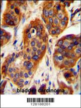 LRRC57 Antibody (C-term) (Cat. #AP10537b) immunohistochemistry analysis in formalin fixed and paraffin embedded human bladder carcinoma followed by peroxidase conjugation of the secondary antibody and DAB staining. This data demonstrates the use of the LRRC57 Antibody (C-term) for immunohistochemistry. Clinical relevance has not been evaluated.