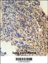 ZNF197 antibody (N-term) (Cat. #AP10532a) immunohistochemistry analysis in formalin fixed and paraffin embedded human lung carcinoma followed by peroxidase conjugation of the secondary antibody and DAB staining. This data demonstrates the use of the ZNF197 antibody (N-term) for immunohistochemistry. Clinical relevance has not been evaluated.