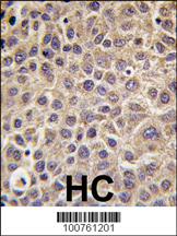 Formalin-fixed and paraffin-embedded human hepatocarcinoma tissue reacted with MTMR8 antibody (C-term), which was peroxidase-conjugated to the secondary antibody, followed by DAB staining. This data demonstrates the use of this antibody for immunohistochemistry; clinical relevance has not been evaluated.