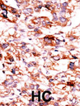 Formalin-fixed and paraffin-embedded human cancer tissue reacted with the primary antibody, which was peroxidase-conjugated to the secondary antibody, followed by AEC staining. This data demonstrates the use of this antibody for immunohistochemistry; clinical relevance has not been evaluated. BC = breast carcinoma; HC = hepatocarcinoma.