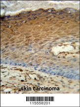 AK7 Antibody (C-term) (Cat. #AP7076d) immunohistochemistry analysis in formalin fixed and paraffin embedded human skin carcinoma followed by peroxidase conjugation of the secondary antibody and DAB staining. This data demonstrates the use of the AK7 Antibody (C-term) for immunohistochemistry. Clinical relevance has not been evaluated.