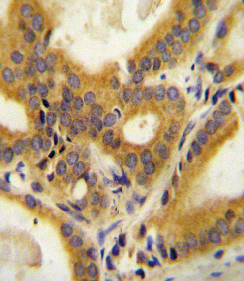 CC85C Antibody (N-term) (Cat. #AP10512a) immunohistochemistry analysis in formalin fixed and paraffin embedded human prostate carcinoma followed by peroxidase conjugation of the secondary antibody and DAB staining. This data demonstrates the use of the CC85C Antibody (N-term) for immunohistochemistry. Clinical relevance has not been evaluated.