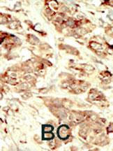 Formalin-fixed and paraffin-embedded human cancer tissue reacted with the primary antibody, which was peroxidase-conjugated to the secondary antibody, followed by DAB staining. This data demonstrates the use of this antibody for immunohistochemistry; clinical relevance has not been evaluated. BC = breast carcinoma; HC = hepatocarcinoma.