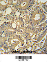TPSD1 antibody (C-term) (Cat. #AP10500b) immunohistochemistry analysis in formalin fixed and paraffin embedded human colon carcinoma followed by peroxidase conjugation of the secondary antibody and DAB staining. This data demonstrates the use of the TPSD1 antibody (C-term) for immunohistochemistry. Clinical relevance has not been evaluated.