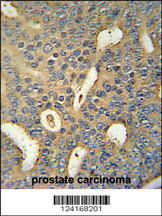 MICALL1 Antibody (C-term) (Cat. #AP10498a) immunohistochemistry analysis in formalin fixed and paraffin embedded human prostate carcinoma followed by peroxidase conjugation of the secondary antibody and DAB staining. This data demonstrates the use of the MICALL1 Antibody (C-term) for immunohistochemistry. Clinical relevance has not been evaluated.