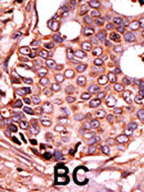 Formalin-fixed and paraffin-embedded human cancer tissue reacted with the primary antibody, which was peroxidase-conjugated to the secondary antibody, followed by DAB staining. This data demonstrates the use of this antibody for immunohistochemistry; clinical relevance has not been evaluated. BC = breast carcinoma; HC = hepatocarcinoma.