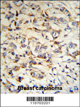CPN2 Antibody (N-term) (RB18703) IHC analysis in formalin fixed and paraffin embedded human breast carcinoma tissue followed by peroxidase conjugation of the secondary antibody and DAB staining. This data demonstrates the use of the CPN2 Antibody (N-term) for immunohistochemistry. Clinical relevance has not been evaluated.