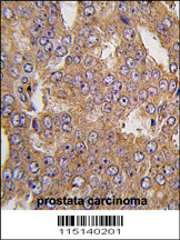 Formalin-fixed and paraffin-embedded human prostata carcinoma tissue reacted with NARS2 antibody (C-term) (Cat.#AP7585b), which was peroxidase-conjugated to the secondary antibody, followed by DAB staining. This data demonstrates the use of this antibody for immunohistochemistry; clinical relevance has not been evaluated.
