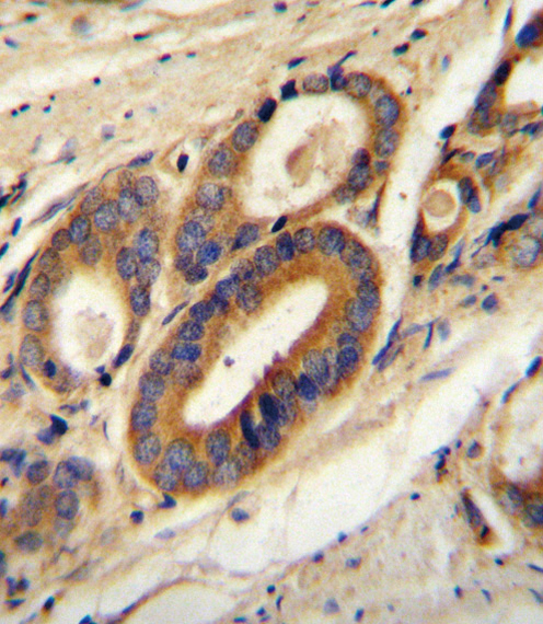 ATP6V0B Antibody (Center) (Cat. #AP10432c) immunohistochemistry analysis in formalin fixed and paraffin embedded human prostate carcinoma followed by peroxidase conjugation of the secondary antibody and DAB staining. This data demonstrates the use of the ATP6V0B Antibody (Center) for immunohistochemistry. Clinical relevance has not been evaluated.