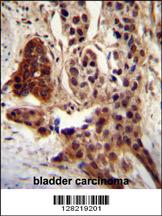 CCDC122 antibody (C-term) (Cat. #AP10856b)immunohistochemistry analysis in formalin fixed and paraffin embedded human bladder carcinoma followed by peroxidase conjugation of the secondary antibody and DAB staining.This data demonstrates the use of CCDC122 antibody (C-term) for immunohistochemistry. Clinical relevance has not been evaluated.