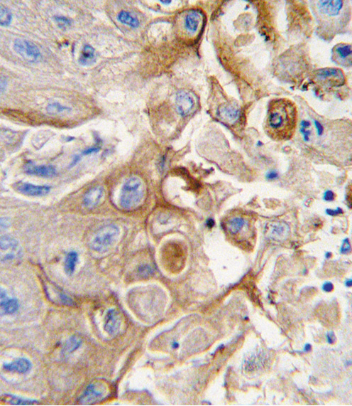 Formalin-fixed and paraffin-embedded human lung carcinoma tissue reacted with CYP2W1 antibody (N-term), which was peroxidase-conjugated to the secondary antibody, followed by DAB staining. This data demonstrates the use of this antibody for immunohistochemistry; clinical relevance has not been evaluated.