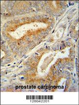 BCORL1 antibody (N-term) (Cat. #AP10847a) immunohistochemistry analysis in formalin fixed and paraffin embedded human prostate carcinoma followed by peroxidase conjugation of the secondary antibody and DAB staining. This data demonstrates the use of the BCORL1 antibody (N-term) for immunohistochemistry. Clinical relevance has not been evaluated.