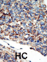 Formalin-fixed and paraffin-embedded human cancer tissue reacted with the primary antibody, which was peroxidase-conjugated to the secondary antibody, followed by AEC staining. This data demonstrates the use of this antibody for immunohistochemistry; clinical relevance has not been evaluated. BC = breast carcinoma; HC = hepatocarcinoma.