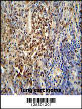 PUS3 antibody (N-term) (Cat. #AP10835a) immunohistochemistry analysis in formalin fixed and paraffin embedded human lung carcinoma followed by peroxidase conjugation of the secondary antibody and DAB staining. This data demonstrates the use of the PUS3 antibody (N-term) for immunohistochemistry. Clinical relevance has not been evaluated.