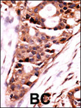 Formalin-fixed and paraffin-embedded human cancer tissue reacted with the primary antibody, which was peroxidase-conjugated to the secondary antibody, followed by AEC staining. This data demonstrates the use of this antibody for immunohistochemistry; clinical relevance has not been evaluated. BC = breast carcinoma; HC = hepatocarcinoma.