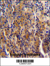SYNE3 antibody (C-term) (Cat. #AP10823b) immunohistochemistry analysis in formalin fixed and paraffin embedded human hodgkin lymphoma followed by peroxidase conjugation of the secondary antibody and DAB staining.This data demonstrates the use of SYNE3 antibody (C-term) for immunohistochemistry. Clinical relevance has not been evaluated.