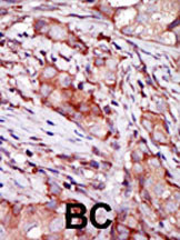 Formalin-fixed and paraffin-embedded human cancer tissue reacted with the primary antibody, which was peroxidase-conjugated to the secondary antibody, followed by AEC staining. This data demonstrates the use of this antibody for immunohistochemistry; clinical relevance has not been evaluated. BC = breast carcinoma; HC = hepatocarcinoma.