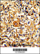 Formalin-fixed and paraffin-embedded human breast carcinoma with PTAR1 Antibody (Center), which was peroxidase-conjugated to the secondary antibody, followed by DAB staining. This data demonstrates the use of this antibody for immunohistochemistry; clinical relevance has not been evaluated.