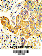 Formalin-fixed and paraffin-embedded human Lung carcinoma reacted with RARS2 Antibody (C-term), which was peroxidase-conjugated to the secondary antibody, followed by DAB staining. This data demonstrates the use of this antibody for immunohistochemistry; clinical relevance has not been evaluated.