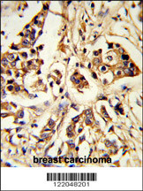 Formalin-fixed and paraffin-embedded human breast carcinoma reacted with ARHGAP18 Antibody (Center), which was peroxidase-conjugated to the secondary antibody, followed by DAB staining. This data demonstrates the use of this antibody for immunohistochemistry; clinical relevance has not been evaluated.